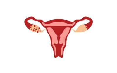 Cyst in Ovary – Ovarian cysts
