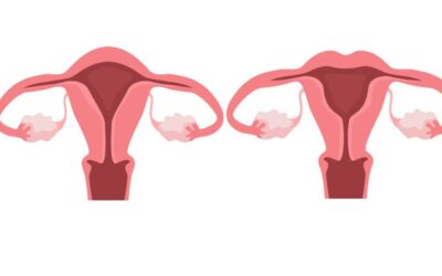 Why do I need hysterectomy?