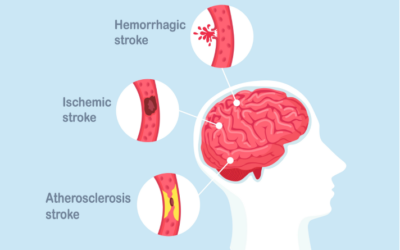 What is stroke?