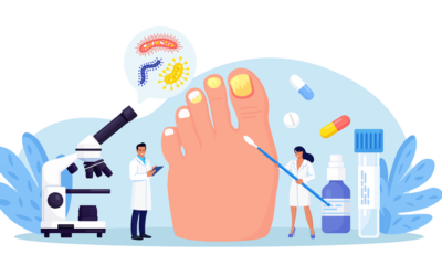 Bunions on feet – Causes, Symptoms, Management