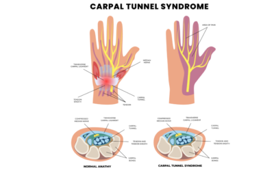 Carpal-tunnel syndrome
