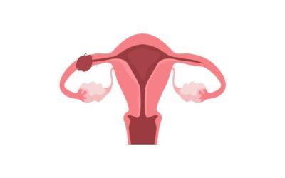 Ectopic pregnancy – Pregnancy outside the womb