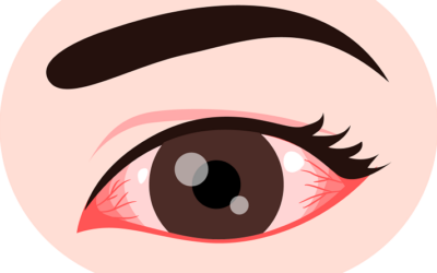 Conjunctivitis – Pink Eye