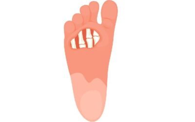 Gangrene Treatment and Prevention