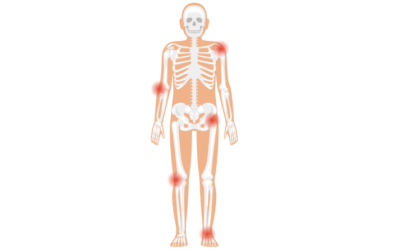What is inflammation?