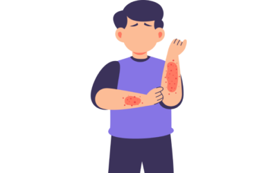 Itching – What is it?