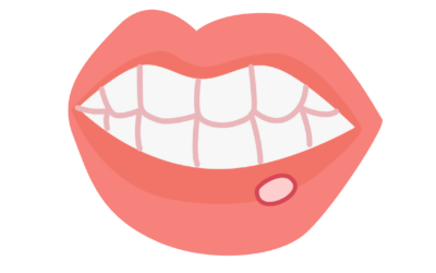 Mouth ulcers